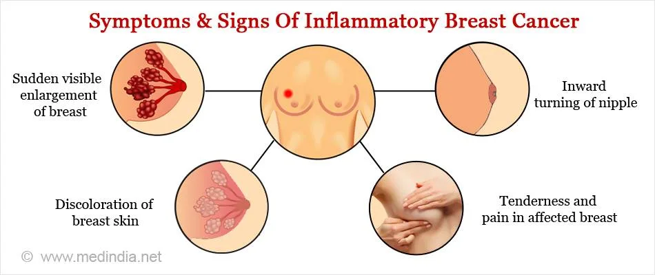 symptoms-inflammatory-breast-cancer